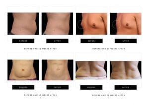 CoolSculpting London - Fat freezing treatments