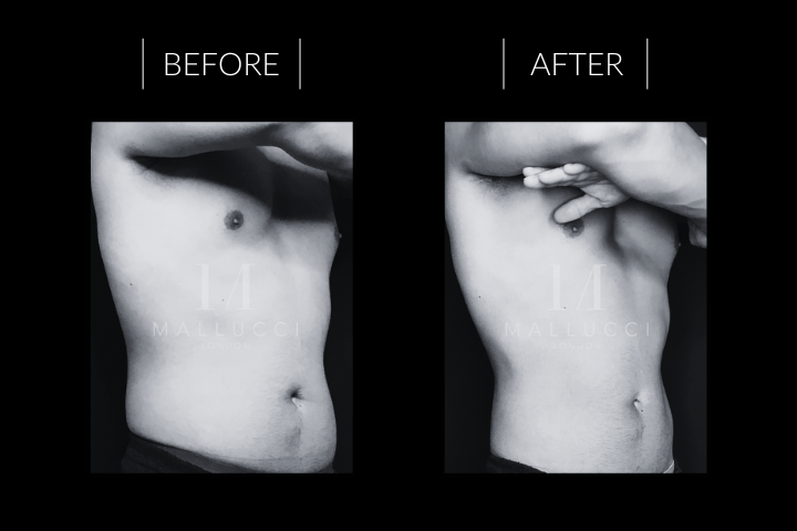 CoolSculpting Results London